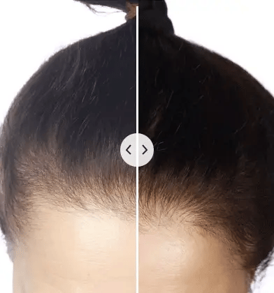 HeadSpa™ - Electric Hair Rejuvenator